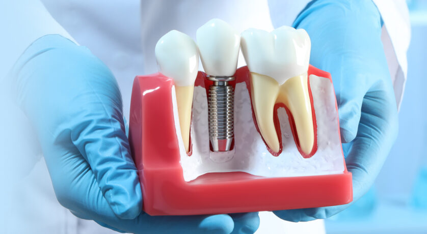 What are Dental Implants: Procedure, Types, Benefits, and Recovery
