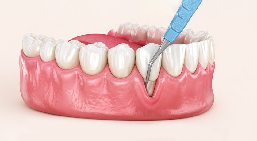 What is Crown Lengthening: Procedure, Benefits, Cost & Recovery Tips
