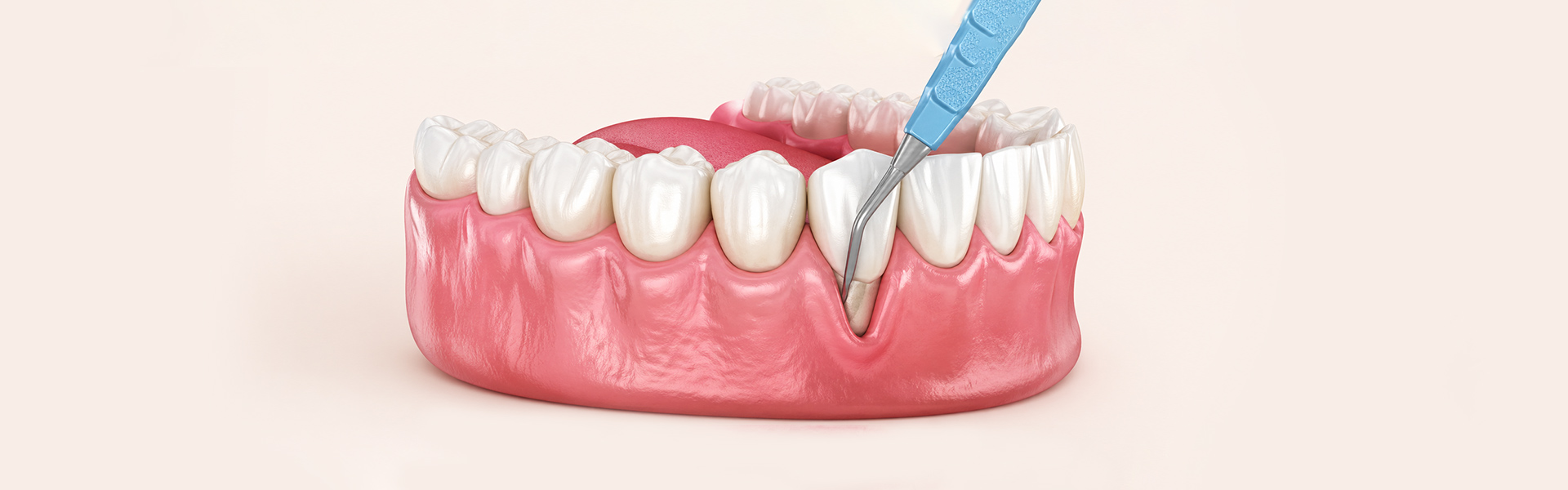 What is Crown Lengthening: Procedure, Benefits, Cost & Recovery Tips