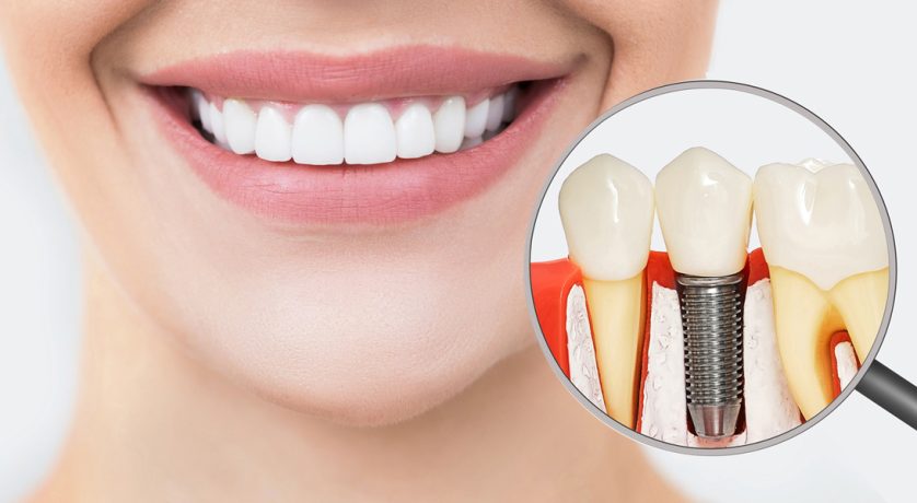 Dental Implants in Bridge City, TX, Dental Implants near me