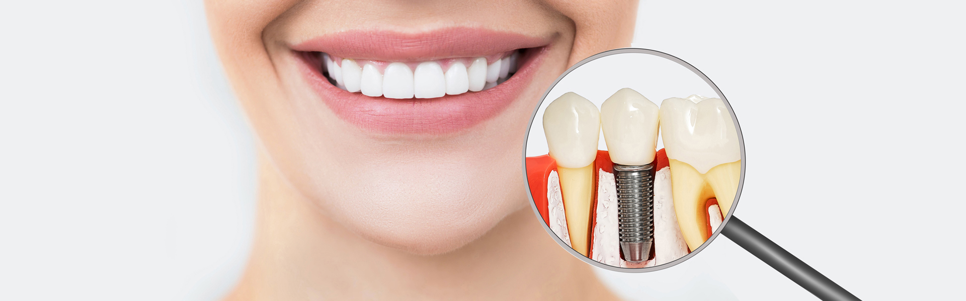 Dental Implants in Bridge City, TX, Dental Implants near me