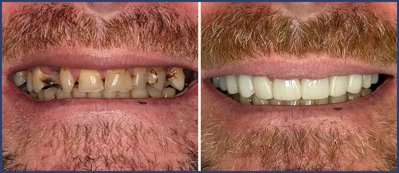 Before After