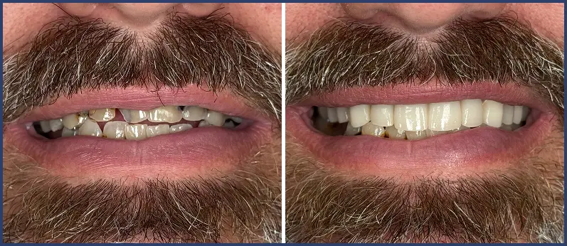Before After