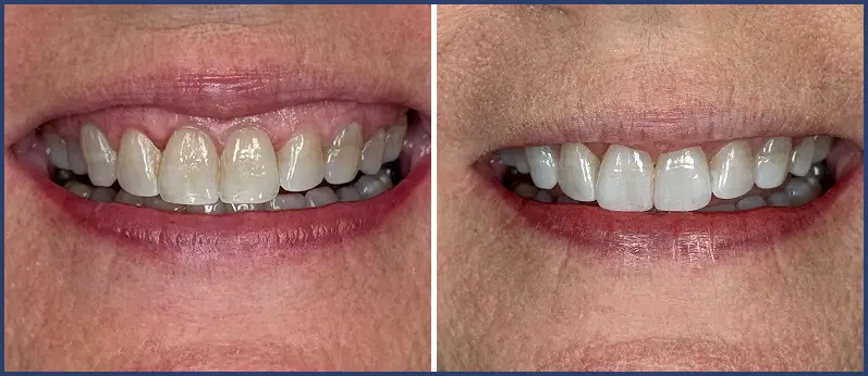 Before After