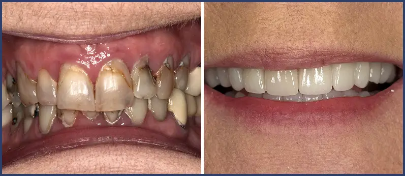 Before After