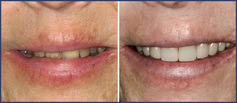 Before After