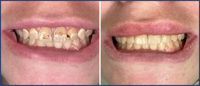 Before After