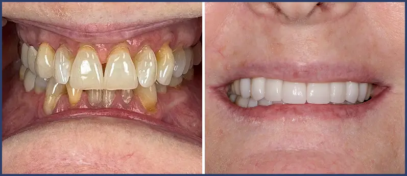 Before After
