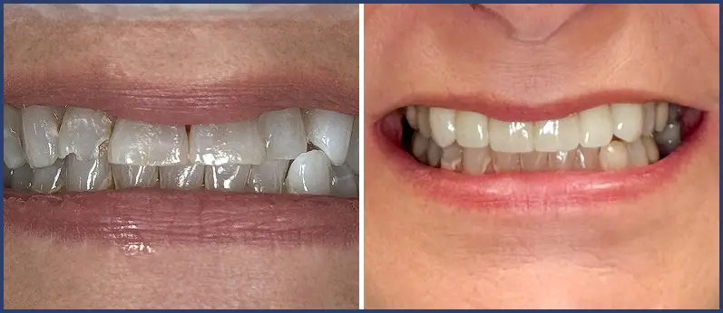 Before After