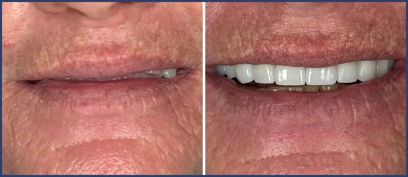 Before After