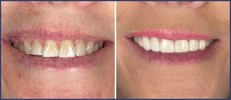 Before After