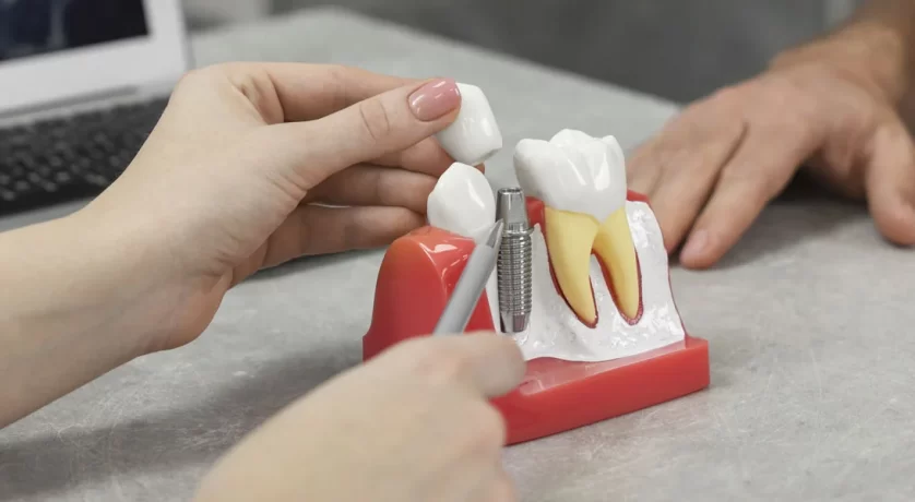 Dental Implants in Bridge City, TX, Dental Implants near you