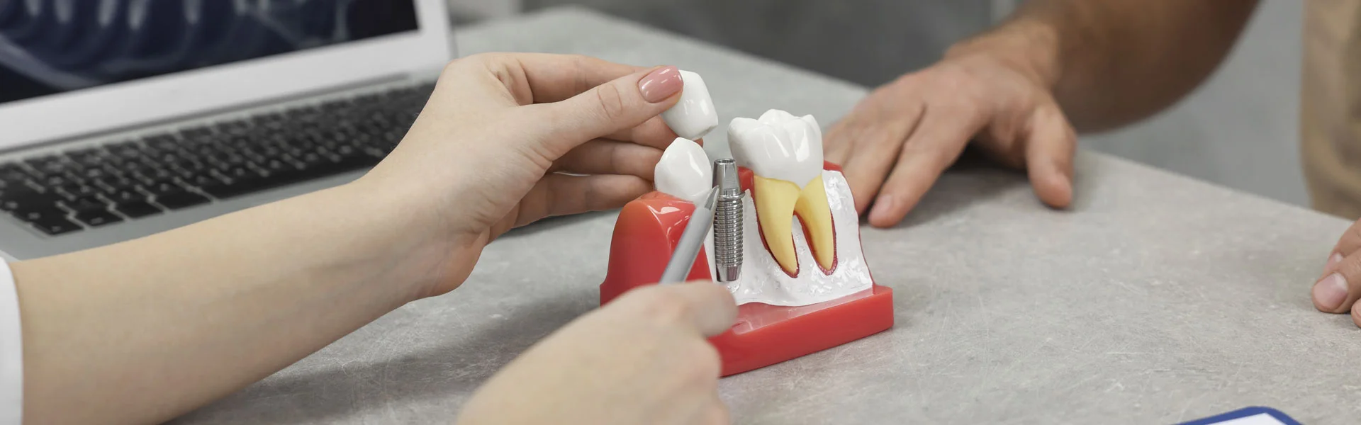 Dental Implants in Bridge City, TX, Dental Implants near you